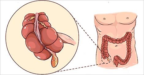 Appendicitis: Causes, Symptoms, Prevention & Diet