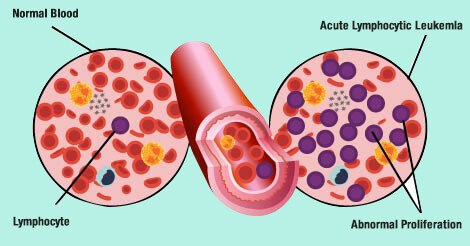 Blood Cancer Types and Stages