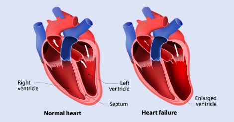 Know About Congestive Heart Failure Symptoms in Men