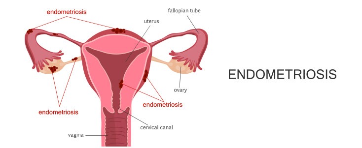 Genetic Causes of Endometrial Cancers