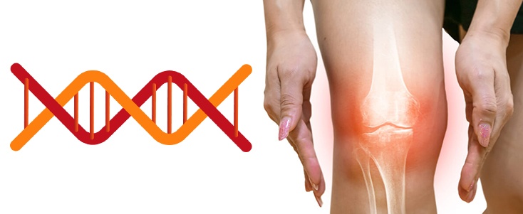 Know Your Genetic Likelihood For Osteoarthritis To Prevent It