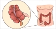 Appendicitis: Causes, Symptoms, Prevention & Diet