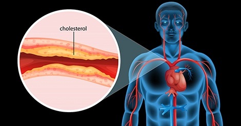 Pain in the Jaw, Armpits, or Back? It Could Be Your Cholesterol!