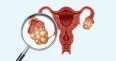 Ovarian Cancer - Overview