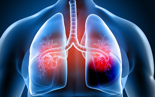 November is Chronic Obstructive Pulmonary Disease Awareness Month