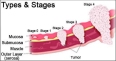 Stomach Cancer - Types & Stages