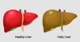 Unhealthy Lifestyle and Fatty Liver Disease: Know them to prevent them