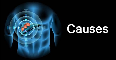 Liver Cancer - Causes and Risk Factors