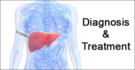 Liver Cancer Diagnosis & Treatment