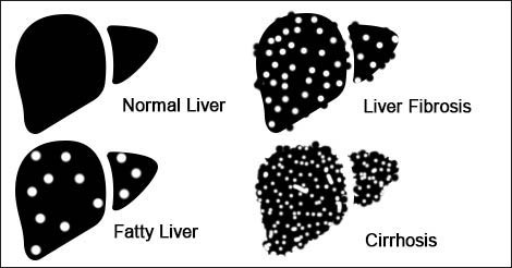 Liver Cancer - Types and Stages