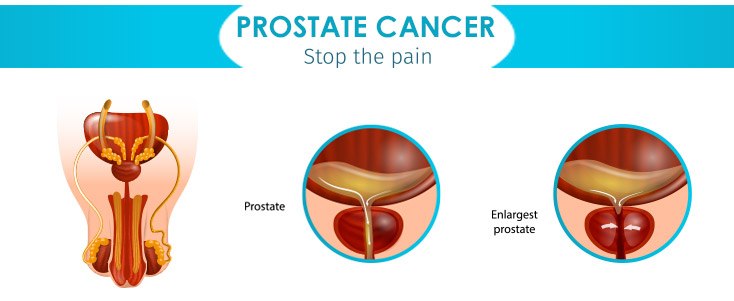 Does Inheritance Help In Prostate Cancer Prevention