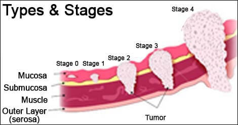 Stomach Cancer - Types & Stages