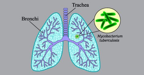 Tuberculosis (TB) Causes, Risk Factors, Test and Prevention