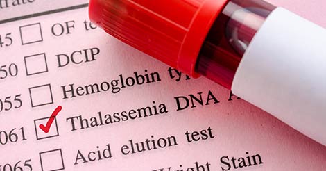 Thalassemia: A Wake up Call