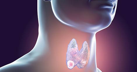 Throat Cancer - Signs & Symptoms