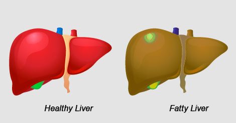 Unhealthy Lifestyle and Fatty Liver Disease: Know them to prevent them
