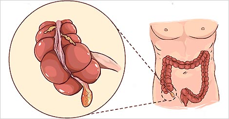 appendix pain in children