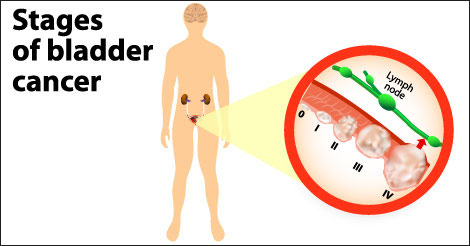Bladder Cancer - Types & Stages