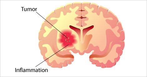 Infographic: 8 Warning Signs Of A Brain Tumor | Moffitt