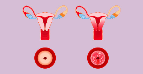 Cervical Cancer Stages Types Of Cervical Cancer