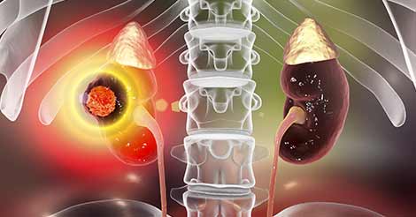 Know Everything about Chronic Kidney Diseases