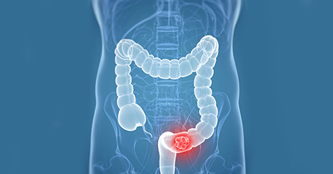Is Your Diet Related To Colon Cancer Risk?