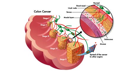Colon Cancer Types And 4 Different Stages