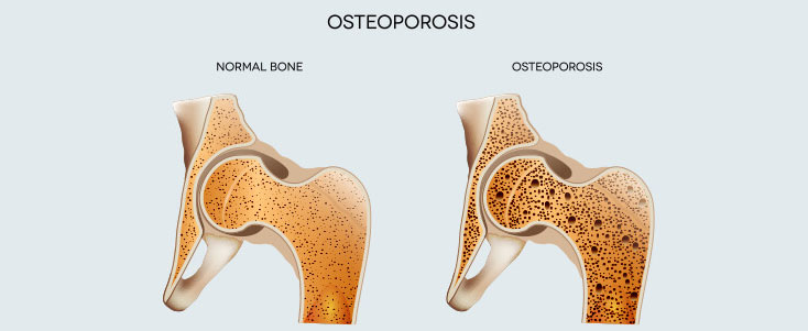 Osteoporosis - 5 Ways to Improve Bone Density