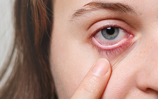 Avoid Risk of Eye Infections in Monsoon