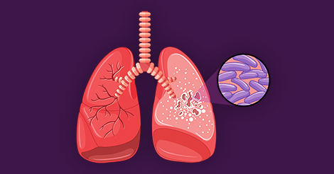 Can Tuberculosis Be Prevented OR Cured?