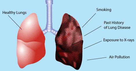 Lung Cancer - Causes & Risk Factors