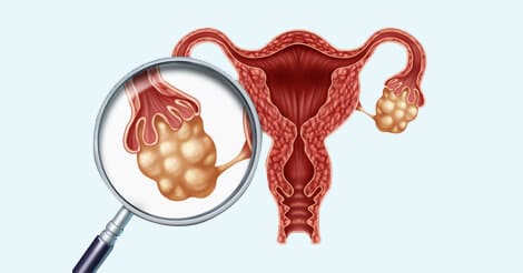 Ovarian Cancer Causes & Risk Factors | Types & Stages