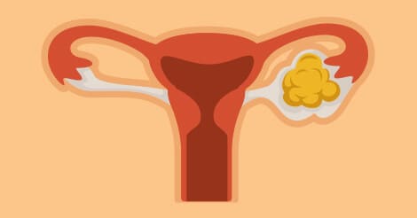 Ovarian Cancer - Types & Stages