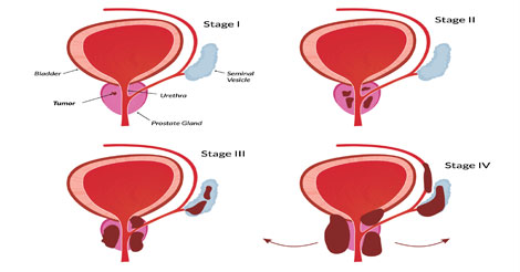 Prostate Cancer - Causes, Stages and Prevention