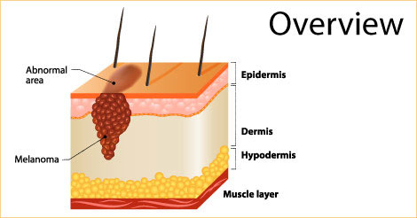Skin Cancer - Overview