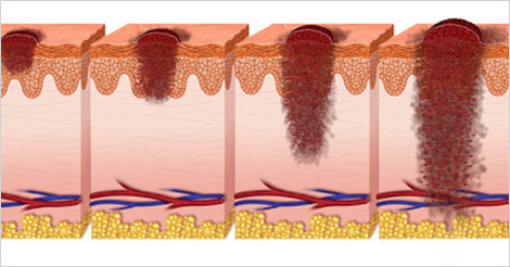 Skin Cancer Types Stages Different Levels
