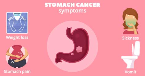 Stomach Cancer Signs & Symptoms of Early & Final Stages