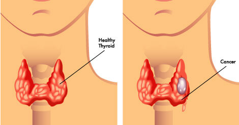 Thyroid Cancer, Causes, Symptoms, Treatment & Prevention